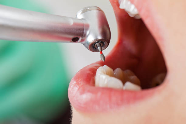 Best Emergency Treatment for Dental Infections or Abscesses in Clarksdale, MS